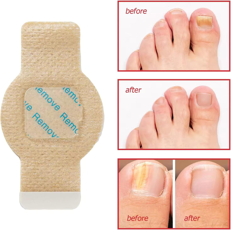 Fungal Nail Patches 21 patches in 1 pack ( Buy 1 get 1 free