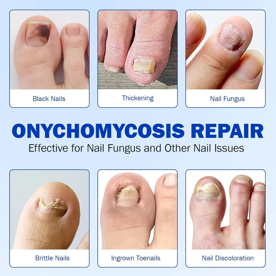 Fungal Nail Patches 21 patches in 1 pack ( Buy 1 get 1 free
