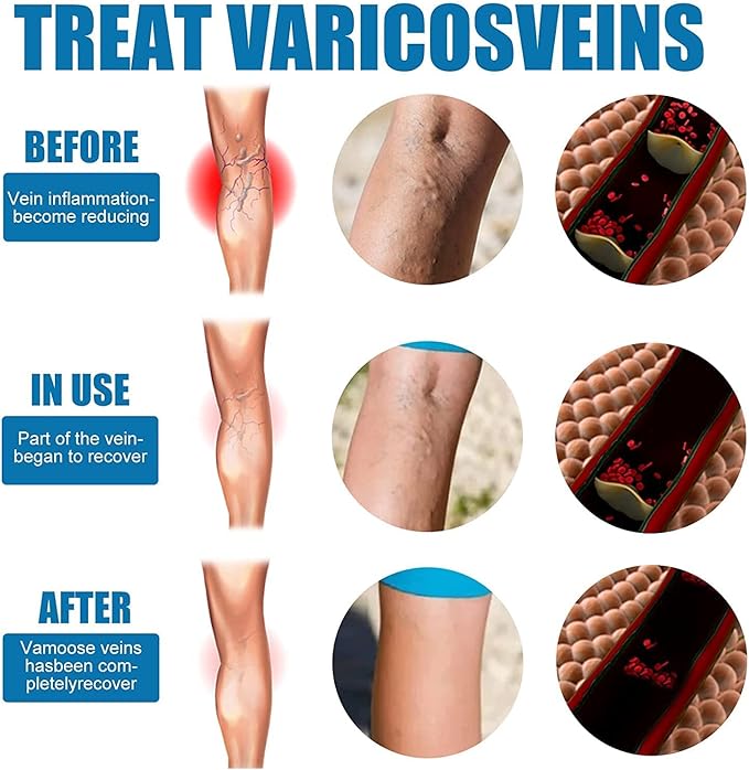 varicose spray
